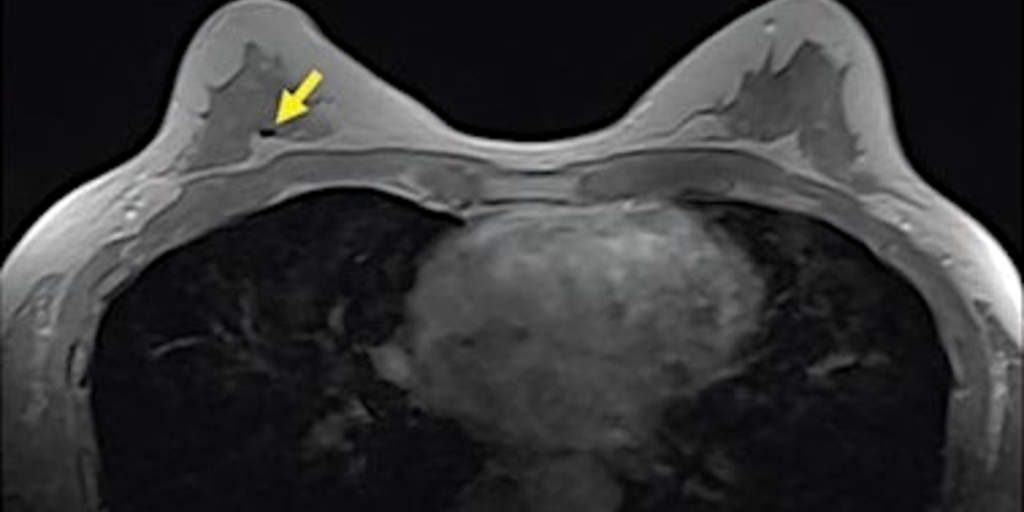 New scoring system for 'second look' breast lesions could decrease